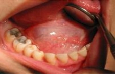 Dil Altı Tükürük Bezi İltihabı Belirtileri ve Tedavisi Dil Altı Tükürük Bezi İltihabı Belirtileri ve Tedavisi