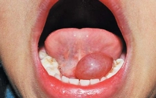 Tükürük Bezi Kisti Belirtileri ve Tedavisi Tükürük Bezi Kisti Belirtileri ve Tedavisi