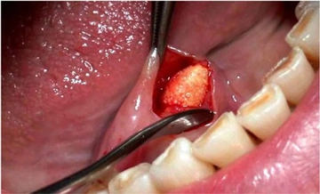 Dil Altı Tükürük Bezi Şişmesi Dil Altı Tükürük Bezi Şişmesi