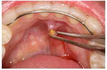 Tükürük Bezi Taşı Ameliyatı Riskleri ve Sonrası Tükürük Bezi Taşı Ameliyatı Riskleri ve Sonrası